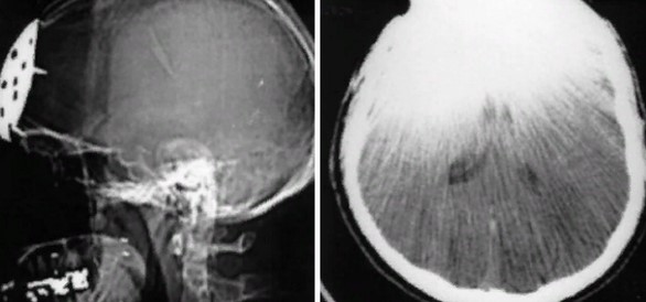 Пример изображения КТ головного мозга с артефактом из-за металла