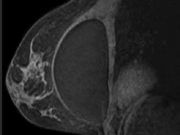 МР-снимок молочной железы с имплантатом