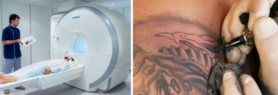 МР-сканирование у пациента с татуировкой
