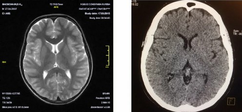 МРТ (справа) и КТ (слева) головного мозга