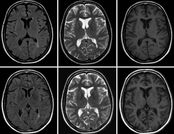 Снимки, полученные при магнитно-резонансной томографии мозга