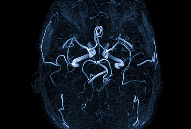 МРТ ангиография сосудов головного мозга