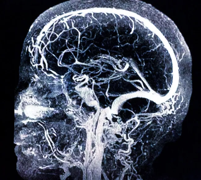 МРТ ангиография сосудов головного мозга