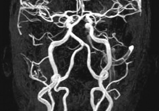 МРТ шеи с МР-ангиографией
