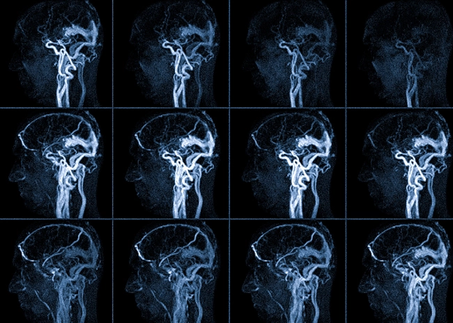 Послойные снимки при МРТ ангиографии сосудов головного мозга