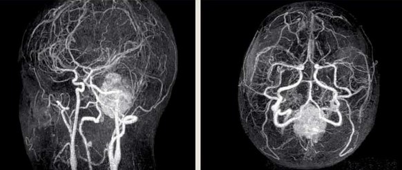 Субарахноидальное кровоизлияние на снимке МРТ с МР-ангиографией