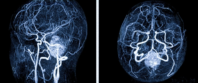 Субарахноидальное кровоизлияние на снимке МРТ с МР-ангиографией