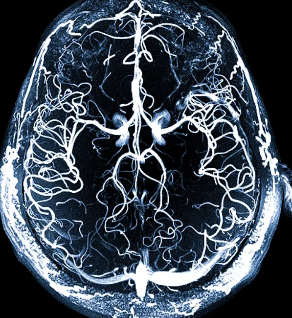 МРТ ангиография сосудов головы