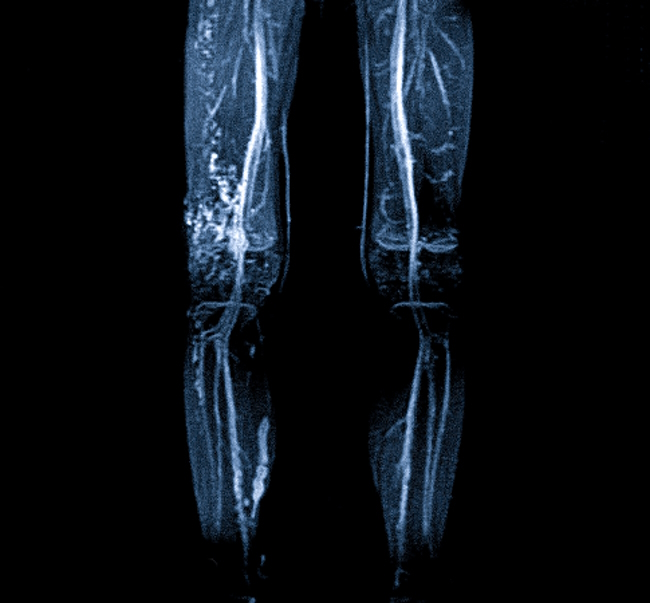 МРТ ангиография сосудов ног