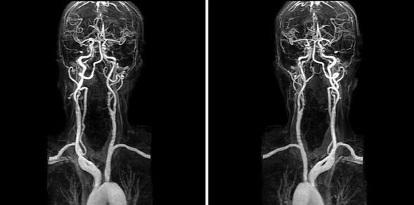  МРТ шеи с контрастной МР-ангиографией