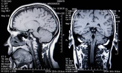 Мрт головного мозга опухоль гипофиза
