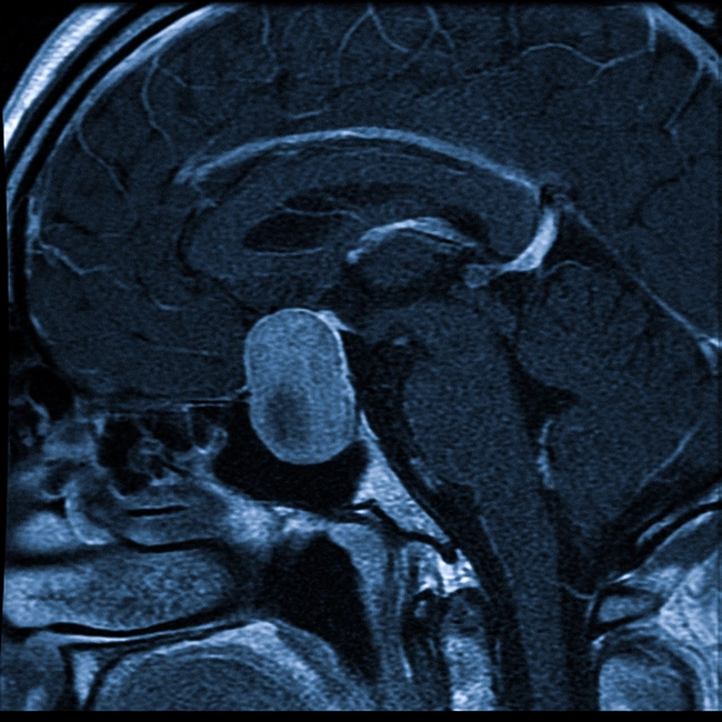 Гигантская аденома гипофиза на МРТ
