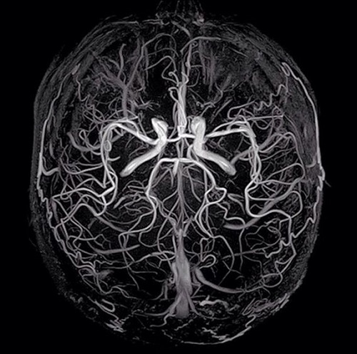 3D-модель церебральных артерий и вен