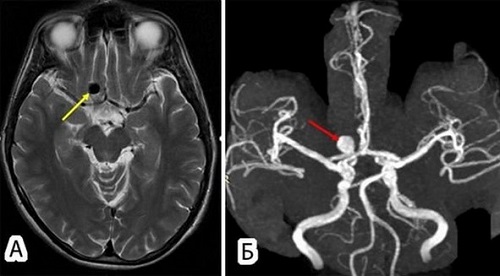 Аневризма (стрелка) на снимке МРТ головного мозга (А) и в режиме ангиографии (Б)