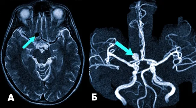 Аневризма (стрелка) на снимке МРТ головного мозга (А) и в режиме ангиографии (Б)