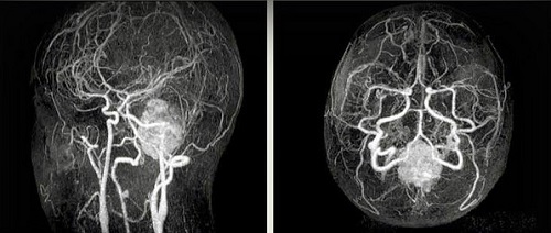 Субарахноидальная гематома на снимках МР-ангиографии