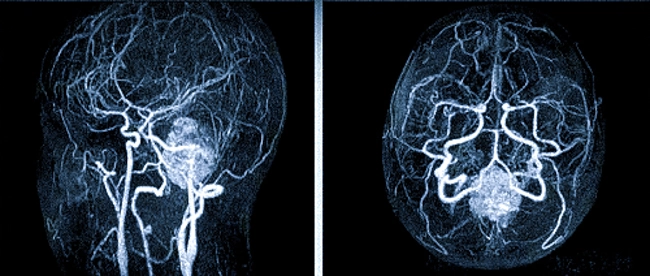 Субарахноидальная гематома на снимках МР-ангиографии