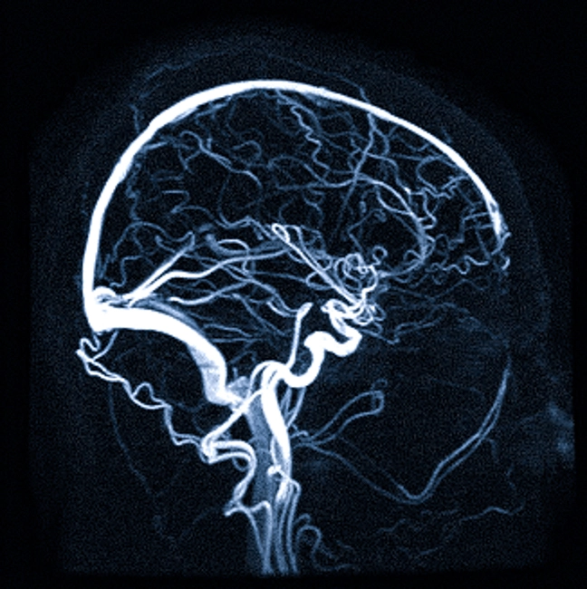 Ангиограмма сосудов головного мозга