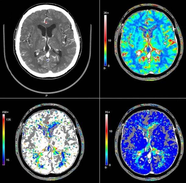 МР-спектроскопия головного мозга