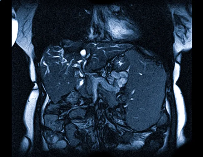 Органы брюшной полости на МР-скане