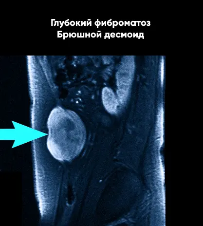 Опухоль передней брюшной стенки