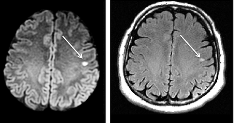 На МР-снимках в последовательностях DWI (слева) и FLAIR (справа) визуализируется лакунарный ишемический инсульт