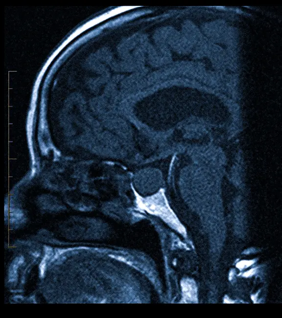Аденома гипофиза на МРТ