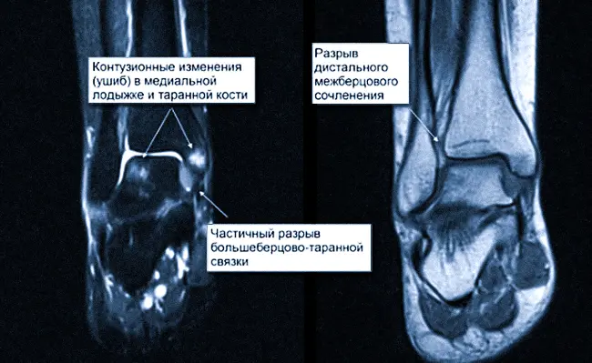 МРТ голеностопа при травме