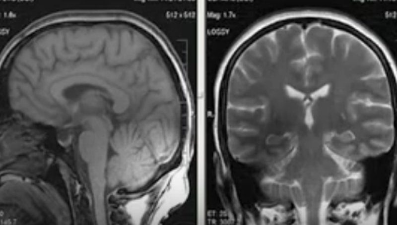 МРТ головного мозга в норме