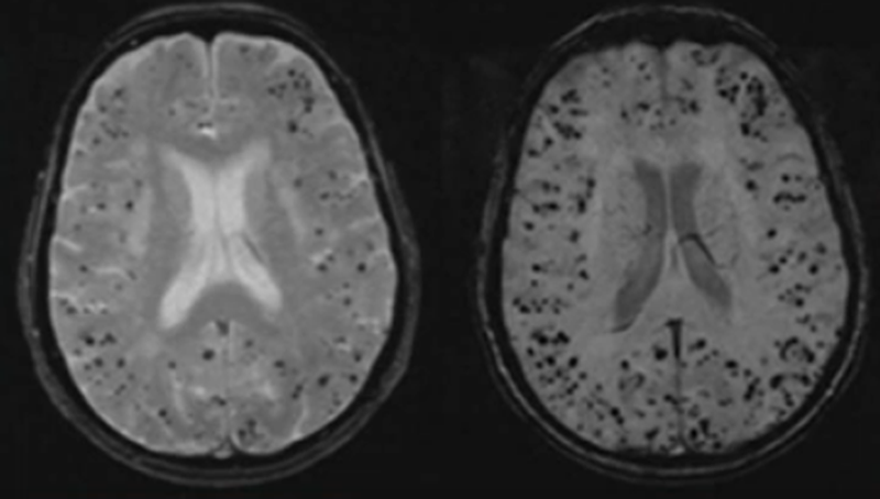 Амилоидная ангиопатия на МРТ головного мозга