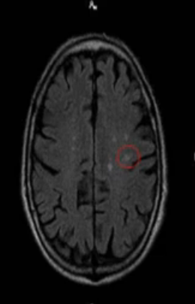 Лакунарный инфаркт головного мозга на МРТ