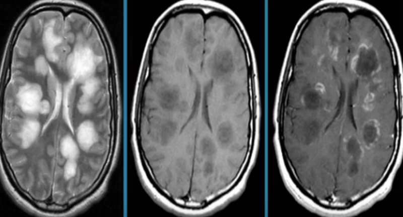 Энцефаломиелит на МРТ головного мозга