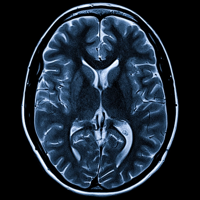 МРТ головного мозга в аксиальной проекции