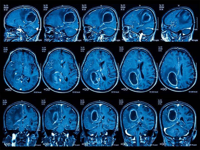 Опухоль на МРТ головного мозга