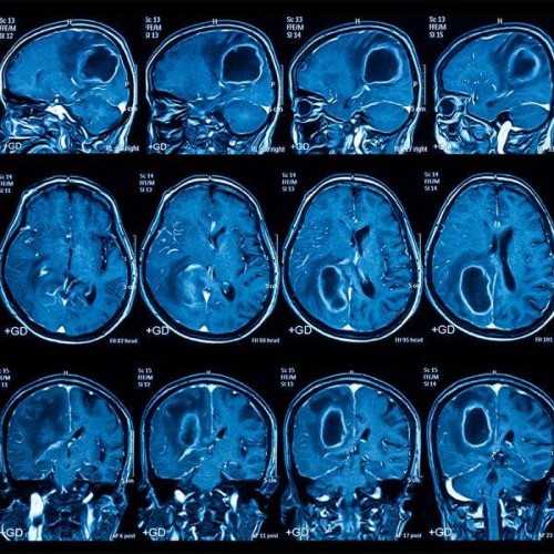 МРТ головного мозга для профилактики