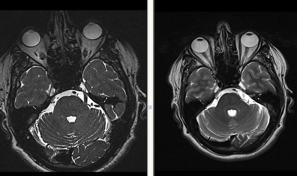 Снимки МРТ головного мозга при подозрении на вазоневральный конфликт (аксиальный срез)
