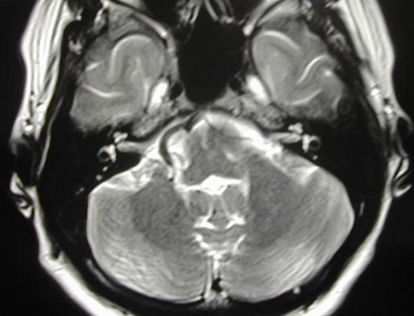 Гемифациальный спазм, снимок МРТ головного мозга