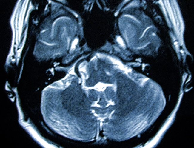 Гемифациальный спазм, снимок МРТ головного мозга