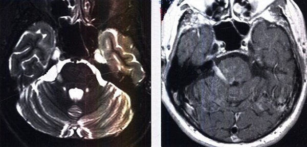 Признаки невралгии тройничного нерва на МРТ
