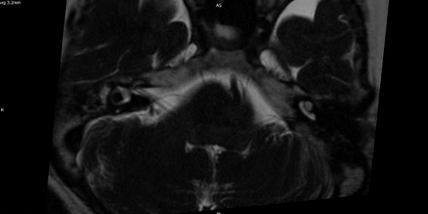 НВК лицевого нерва и передней нижней мозжечковой артерии на МРТ