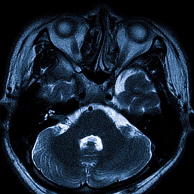 МРТ головного мозга на вазоневральный конфликт