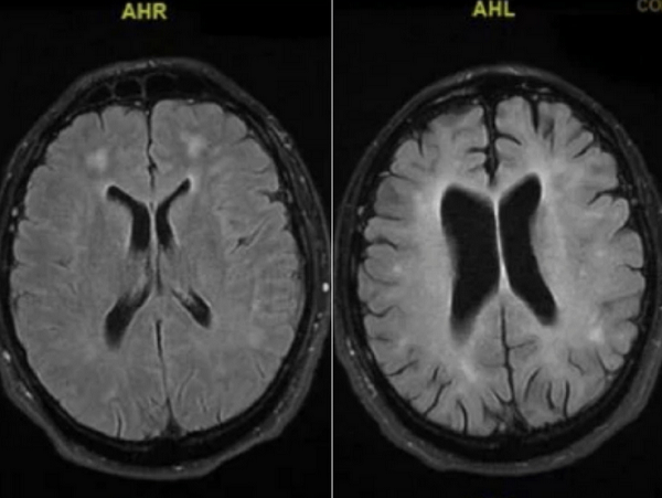 Снимки МРТ церебральных образований