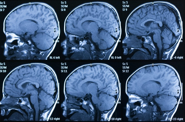 Структурные изменения мозга при психических расстройствах