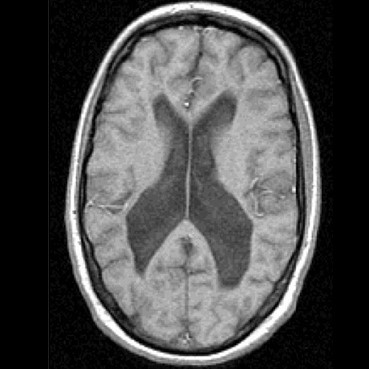 МРТ головного мозга покажет шизофрению