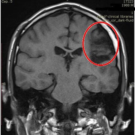 МРТ головного мозга при эпилепсии