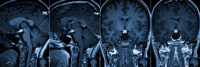 Аденома гипофиза на снимке МРТ