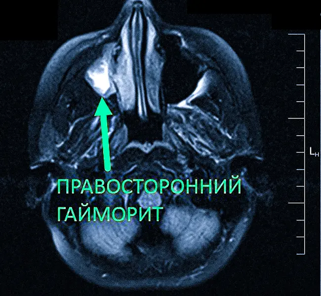 МРТ головы покажет гайморит