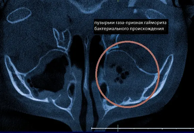 МРТ головы покажет гайморит