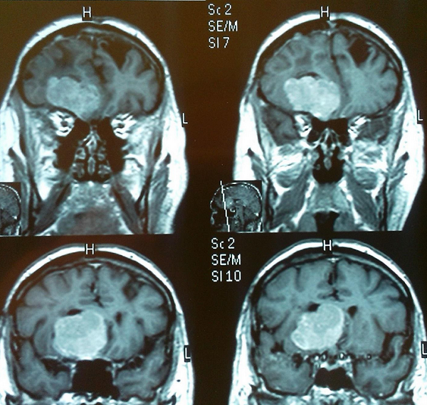 Обследование после иссечения менингиомы основания черепа