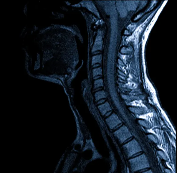 МРТ области шеи